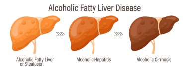 Yağlı karaciğer türleri. İnsan karaciğer hastalıkları. Alkolik yağlı karaciğer hastalığı. Hepatit, karaciğer sirozu, fibroz, steatoz. Tıbbi bilgi pankartı. Vektör