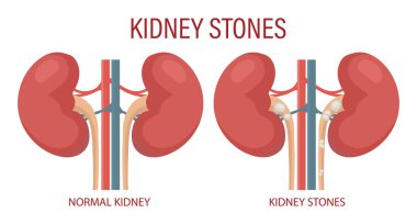 Böbrek taşları. İnsan böbrek hastalığı. Tıbbi bilgi pankartı, illüstrasyon, vektör
