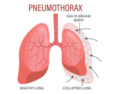 Pnömotoraks, akciğer hastalığı. Sağlık hizmetleri. Tıbbi bilgi pankartı, illüstrasyon, vektör
