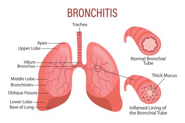 Bronşit, akciğer hastalığı. Sağlık hizmetleri. Tıbbi bilgi pankartı, illüstrasyon, vektör