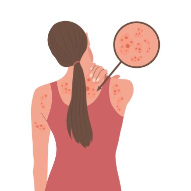 Alerjik kaşıntı, deri iltihabı, kızarıklık ve tahriş. Dermatit, egzama, sedef. Sağlık ve ilaç servisi. Vektör