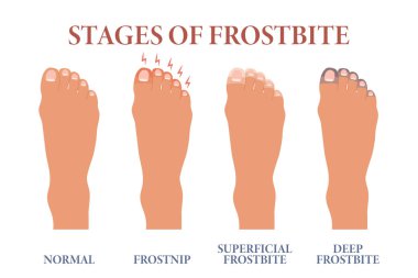 Frozen toes. Stages of frostbite of fingers. Healthcare and medicine. Vector clipart