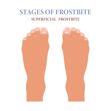 Donmuş ayak parmakları. Parmak soğuğunun aşamaları. Sağlık ve ilaç servisi. Vektör