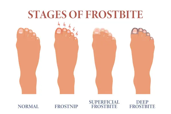 Frozen Toes Stages Frostbite Fingers Healthcare Medicine Vector — Stock Vector