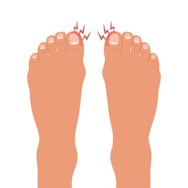 Şişmiş ayak parmağı, onkokriptoz. Tırnak hastalığı ya da enfeksiyonu olan bir ayak. Ayağında onikositoz ya da tırnak mantarı var. Sağlık ve ilaç servisi. Vektör