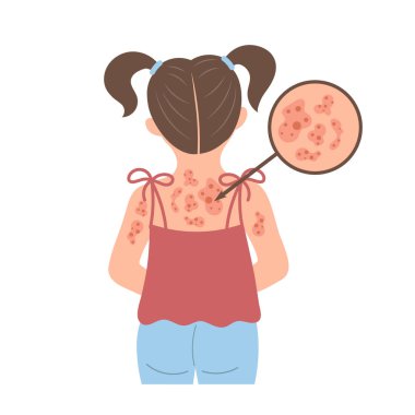 Alerjik kaşıntı, deri iltihabı, kızarıklık ve tahriş. Alerjisi olan bir çocuk. Sağlık ve ilaç servisi. Vektör