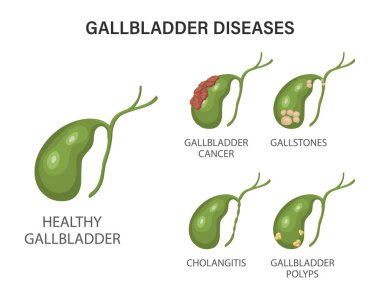 Gallbladder diseases infographics. Gallstone disease, cancer, acute cholecystitis, cholangitis or polyps of the digestive system. Problems with the biliary tract. Illustration. clipart