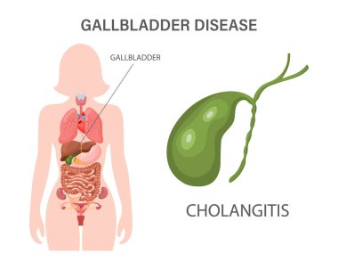 Safra kesesi hastalıkları bilgi pankartı. Safra taşı hastalığı, kanser, kolanjit veya sindirim sisteminin polipleri. İlaç ve sağlık hizmetleri. Görüntü.