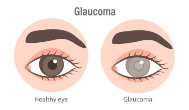 Glaukoma gözü. İltihaplı, neovasküler, travmatik glokom. Tıbbi bilgi pankartı