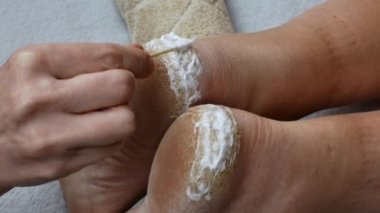 The doctor smears the cracked dry skin of the heel on the leg with a moisturizing healing cream. Close-up of applying cream on sore cracked heels. The concept of skin treatment on the feet.