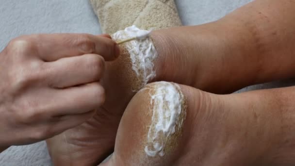 医者は保湿クリームで足のかかとの割れ乾燥肌を汚れます 痛いヒールにクリームを適用するのクローズアップ 足の皮膚治療の概念 — ストック動画
