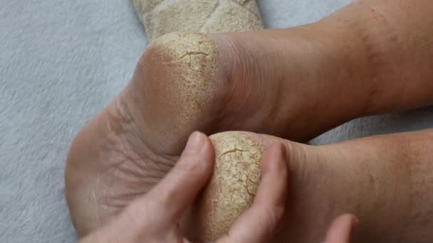 乾燥した割れ問題のある皮膚を持つ人間の足のかかと 足の乾燥したラフ割れ肌に触れる女性の手のクローズアップ 患者を診察する医者の概念はかかとを割られた — ストック動画