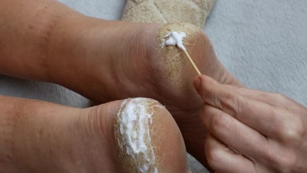 Applying Cream Cracked Heels Close Womans Hand Applying Moisturizing Nourishing — стоковое видео