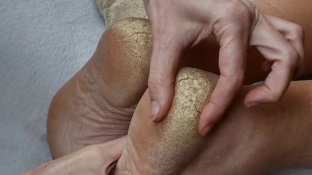 Bir Insanın Ayağında Çatlaklar Ayak Sağlığı Sorunları Ihmal Edilmiş Topuklar — Stok video