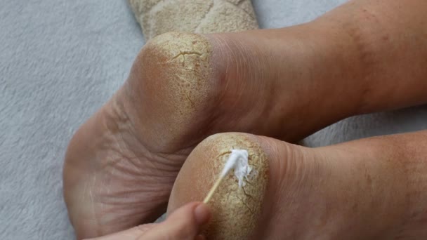 Ferse Mit Trockener Haut Und Rissen Medizinische Fußpflege Ein Orthopäde — Stockvideo