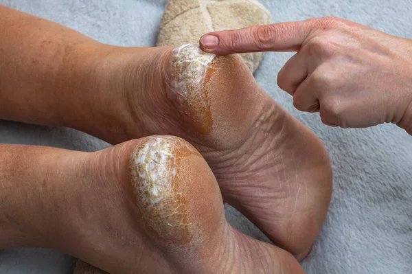 Heel with dry skin and cracks. Medical pedicure. An orthopedic doctor applies a healing cream to the cracked heels of a sick man. The concept of treating cracked heels.