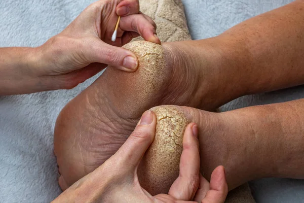 Human foot heels with dry cracked problematic skin. Close-up of female hands touching the dry rough cracked skin of the legs. The concept of a doctor examining a patients cracked heels.