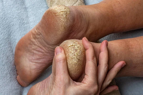 Bir insanın ayağında çatlaklar, ayak sağlığı sorunları, ihmal edilmiş topuklar. Bir doktor, bir adamın çatlak topuklarını muayene eder. Yakın plan. Çatlak topukları tedavi etme kavramı.