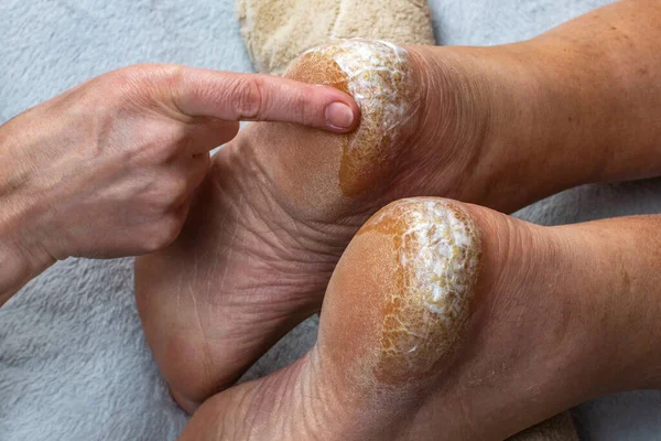 The doctor smears the cracked dry skin of the heel on the leg with a moisturizing healing cream. Close-up of applying cream on sore cracked heels. The concept of skin treatment on the feet.