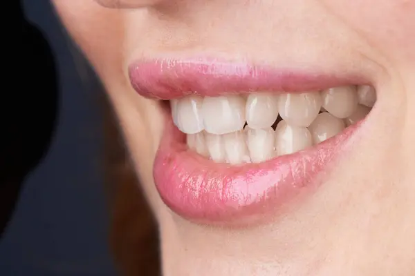 Macro Photography Teeth Beautiful Lips Showcasing Veneers — Stock Photo, Image