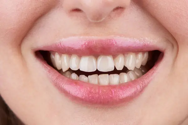 Макрозйомка Зубів Красивими Губами Демонстрація Вінірів — стокове фото