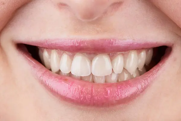 Macro Photography Teeth Beautiful Lips Showcasing Veneers Smiling Lips Teeth — Stock Photo, Image
