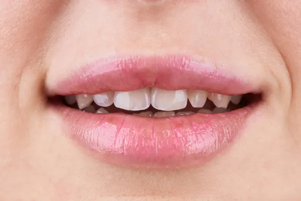 Macro Photography Teeth Beautiful Lips Showcasing Veneers Front Side — Stock Photo, Image