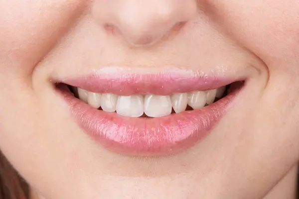 Macro Fotografia Denti Con Belle Labbra Mostra Impiallacciature — Foto Stock