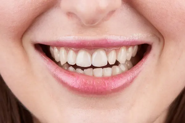 Macro Fotografia Denti Con Belle Labbra Mostra Impiallacciature — Foto Stock