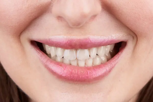 Macro Photography Teeth Beautiful Lips Showcasing Veneers — Stock Photo, Image