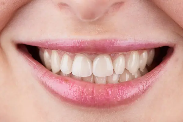 美しい唇を持つ歯のマクロ写真 ベニヤを示し 歯で笑顔の唇 ストック写真