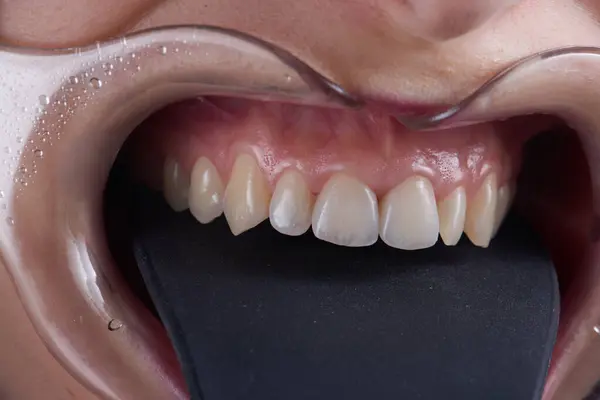 ベニヤが付いている歯のマクロ写真 ロイヤリティフリーのストック写真