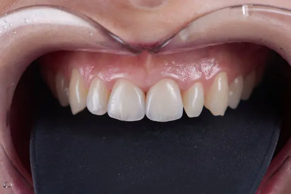 Fotografia Macro Dentes Com Folheados Tiro Frontal Imagem De Stock