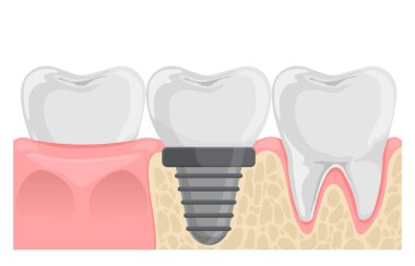 Diş implantı protezi. Diş eti anatomisinde dişler. Düz vektör çizimi beyaz arkaplanda izole edildi.