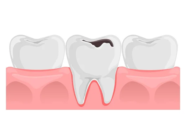 Denti Con Carie Gomma Anatomia Dentale Illustrazione Vettoriale Piatta Isolata — Vettoriale Stock