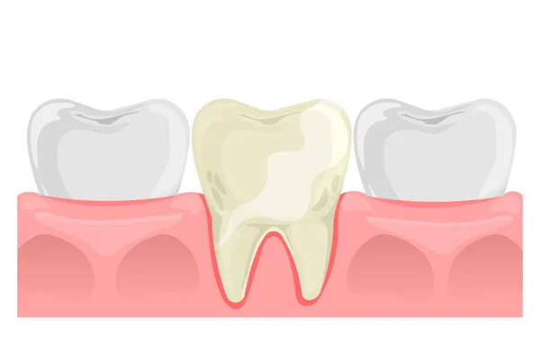 平らなスタイルで黄色の歯 歯と歯茎の解剖学 歯の健康 白を基調としたベクトルイラスト — ストックベクタ