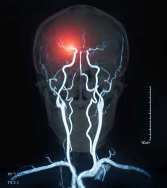 MRI of the blood vessels in the brain and cerebrovascular disease or or hemorrhagic stroke. brain stroke x-ray image. clipart