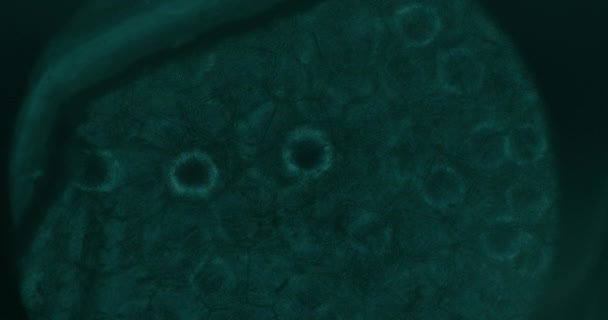 Κοντινό Πλάνο Των Καρκινικών Κυττάρων Κάτω Από Μικροσκόπιο Στο Εργαστήριο — Αρχείο Βίντεο