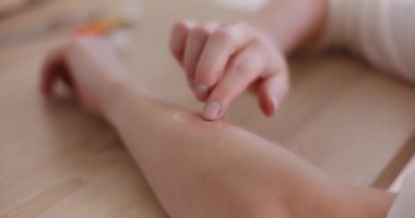 Kadın arı sokmasından sonra eline yatıştırıcı jel sürüyor.