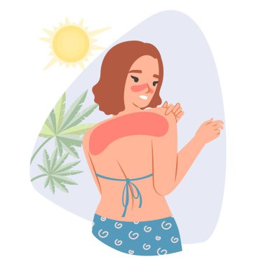 Sunburn vector. Young woman caring of redness shoulders flat cartoon illustration. Girl using sunscreen getting sunburned. Healthy skin concept