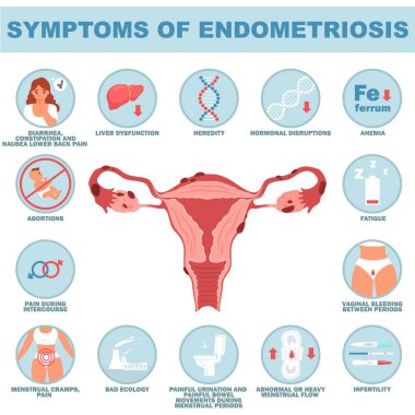Endometriyozis üreme sistemi hastalığının belirtileri. Hasta kadın ve rahim ile tıbbi vektör çizimi. İç organları gelişim dışı.