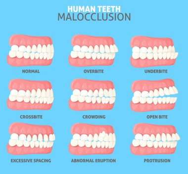 Malocclusion tipleri üst ve alt çene vektör ilüstrasyonunun insan dişleri arasındaki normal, yanlış hizalama ve yanlış ilişki yan görünümü ile ayarlanır