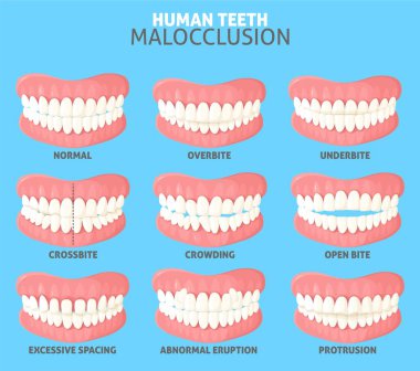 Farklı insan dişleri malocclusion tipleri vektör illüstrasyonunu ayarlar. Ağızda normal ve anormal tıkanma öngörüsü olan tıbbi afiş