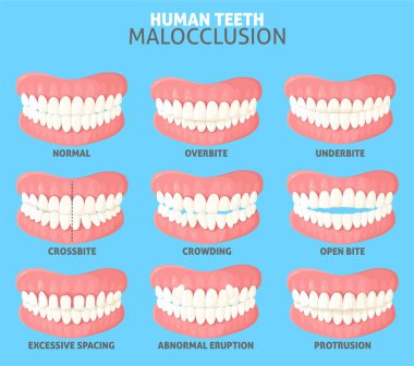 Different human teeth malocclusion types set vector illustration. Medical poster with people mouth jaws with normal and abnormal occlusion front view clipart