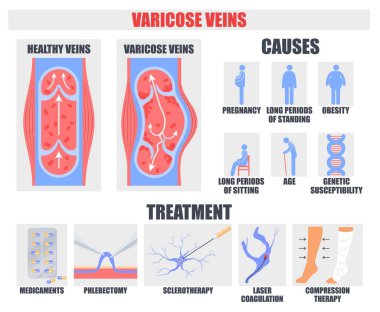 Varisli damar hastalığı tıbbi poster illüstrasyonuna neden olur ve tedavi yöntemleri gösterir. Düzensizliği önlemek ve tedavi etmek için sağlık sorunu ve araç