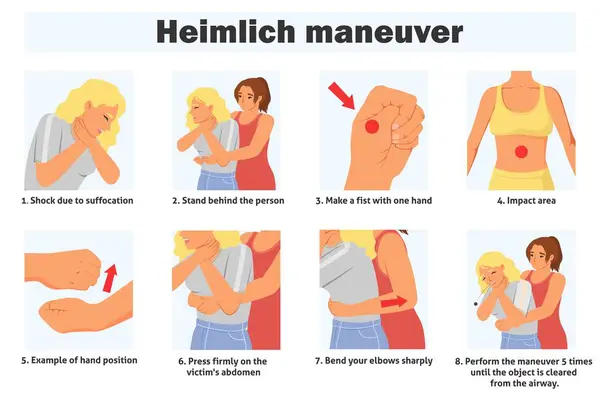 Stock vector Heimlich maneuver infographic poster with steps of first aid and effective technique to save people life. Two young woman demonstrating emergency procedure vector illustration