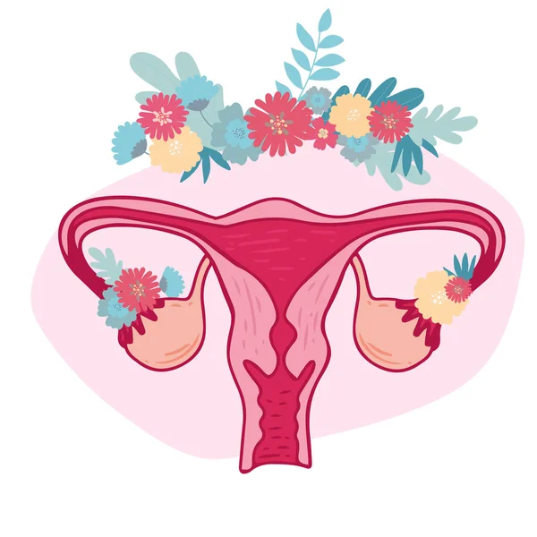 Frauengesundheit Florale Infografik Des Polyzystischen Ovar Syndroms Patientenfreundliches Pcos Schema — Stockvektor