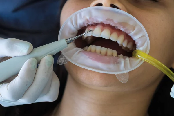 Close-up of hygienic cleaning of teeth from plaque. Dentist\'s hands clean patient\'s teeth from plaque with special device.