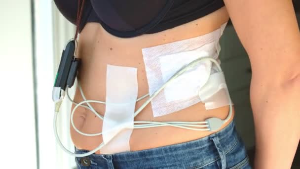 Holter Monitor Dynamic Ecg Weared Woman Bologna Italy Feb 2023 — Video Stock