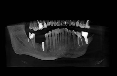 Diş tokasıyla çenenin tomografisi ve dört düzlemde eksik diş.